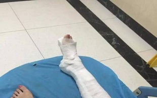 骨折鉴定